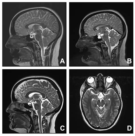 Cerebellar Tonsillar Descent Mimicking Chiari Malformation