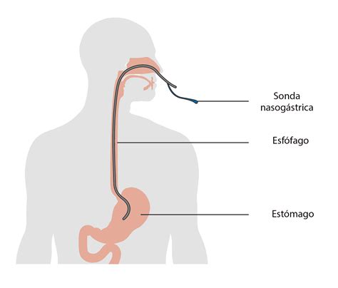 EMS SOLUTIONS INTERNATIONAL marca registrada: INTUBACION NASOGASTRICA ...