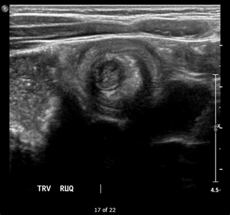 Image result for Definition of Intussusception