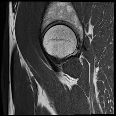 Anatomy Hip Joint Mri at Kenneth Olvera blog