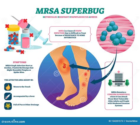 How Fast Can Mrsa Kill You