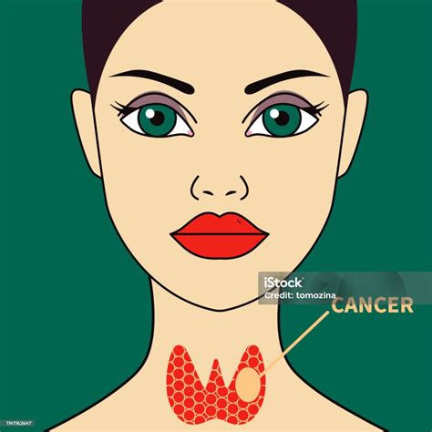Ilustración de El Cáncer De Tiroides En Mujer y más Vectores Libres de Derechos de Adulto ...