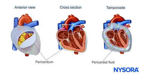 Echocardiography Assessment Of Pericardial Effusion And Cardiac ...
