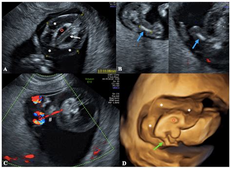 Ultrasound 13 Weeks Pregnant With Twins