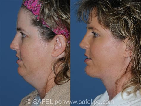 Double Chin Reduction Before and After Pictures Case 350 | SAFELipo®