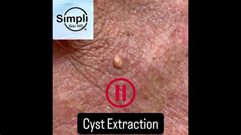 Image result for Cyst Extraction Videos