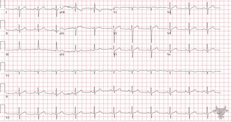 Left Posterior Fascicular Block | ECG Stampede