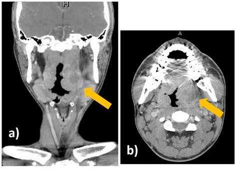 Ultrasound-Guided Needle Aspiration of Peritonsillar Abscesses: Utility of Transoral Pharyngeal ...