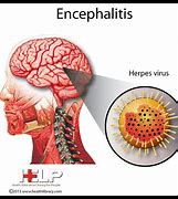 encephalitis 的图像结果