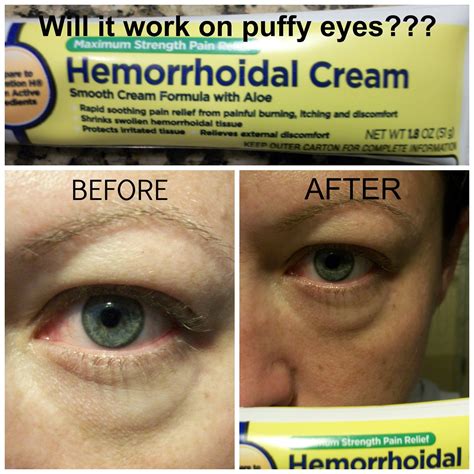 Puffy Eyes Preparation H at Tracy Mcfall blog