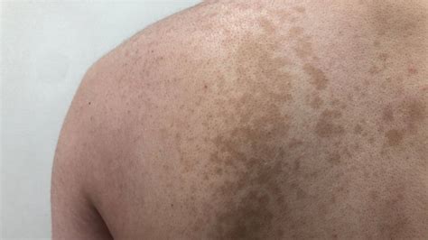 Tinea Versicolor Treatment Before And After