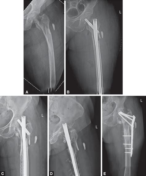 Intramedullary Nailing of Subtrochanteric Fractures: Our Experience