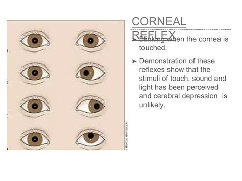 NEONATAL REFLEXES | PPTX
