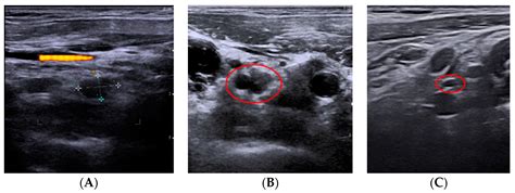 Laser Ablation Treatment of Recurrent Lymph Node Metastases from ...