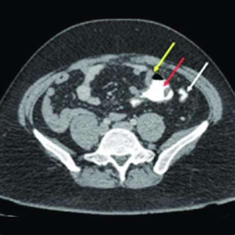 Image result for Appendicitis Left Side