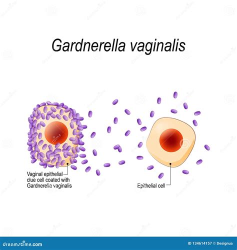 Bacterial Vaginosis Clue Cells Bacterial Vaginosis