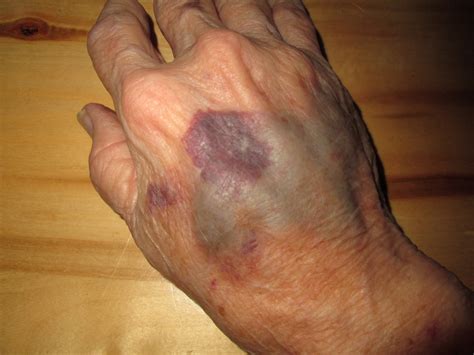 Popped Blood Vessel In Hand