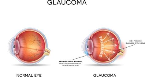 Toda la población está expuesta a sufrir glaucoma; no es solo una ...
