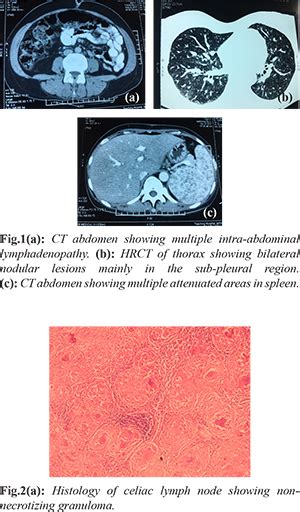 Multidisciplinary Approach: An Essential Step in Diagnosing ...
