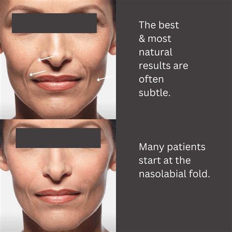 Best Nasolabial Fold Treatments In Australia | Dr Davin Lim