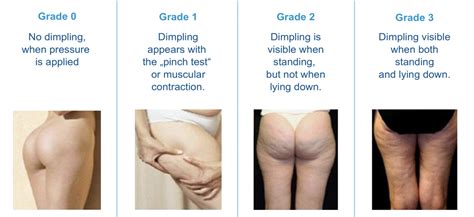 Can Cellulite Go Away