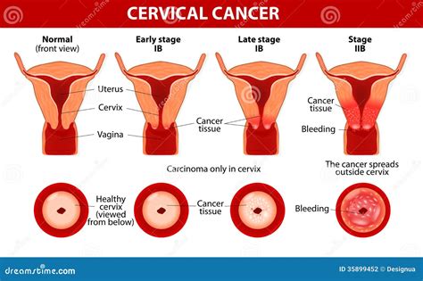 Cervical Cancer. Carcinoma Of Cervix Stock Photography - Image: 35899452