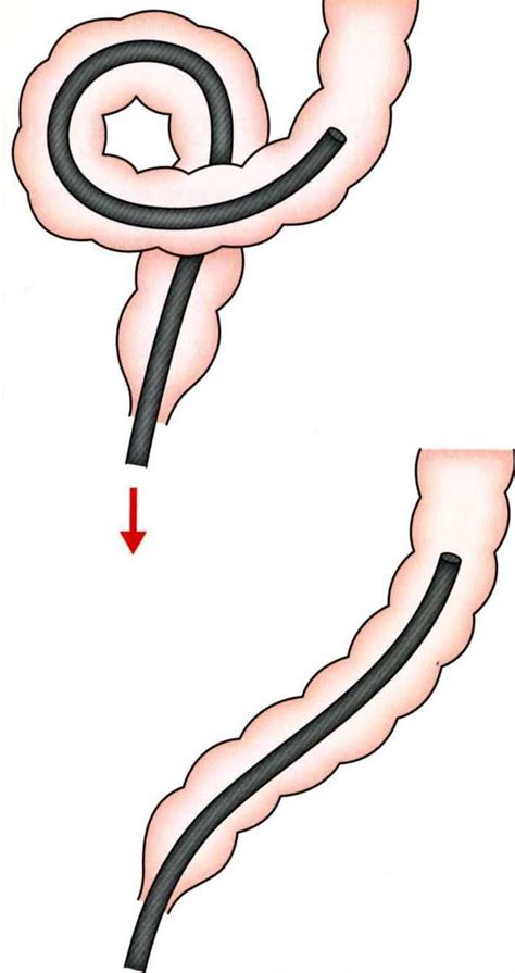 Image result for Colono Looping Colonoscopy