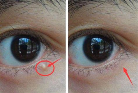 【图】眼睛周边长脂肪粒怎么治疗 3种去除方法介绍(3)_眼睛 脂肪粒_伊秀美容网|yxlady.com