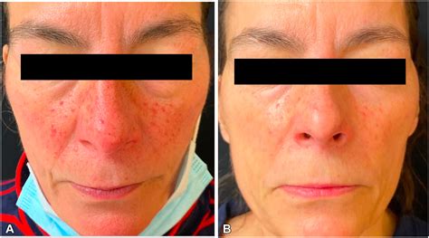 Facial Redness Flushing