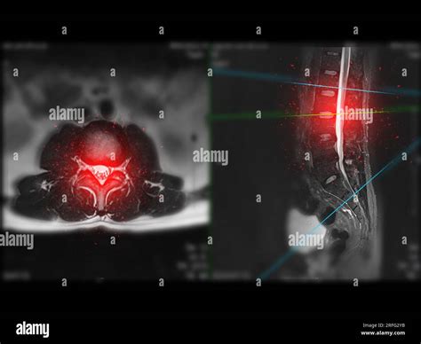 MRI L-S spine or lumbar spine Axial T2W view with sagittal plane for diagnosis spinal cord ...