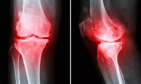 Artificial Intelligence searches an early sign of osteoarthritis from ...