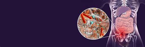 Appendicitis: Causes, Symptoms, and Treatment | Medtalks
