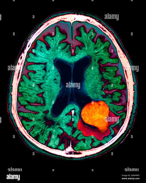 Lesions On The Brain