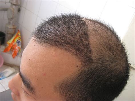 植发变成了这样，是植发失败了吗？植发风险/后遗症有多严重？ - 哔哩哔哩