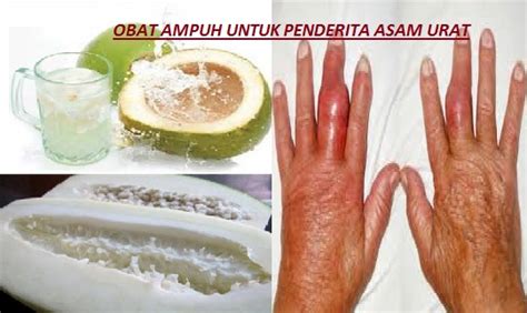 cara menghilangkan asam urat di kaki