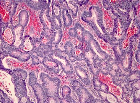 Pathology Outlines - Adenoma overview