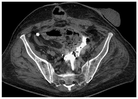 Complications Subsequent to Urinary Tract Stent Placement: An Overview ...