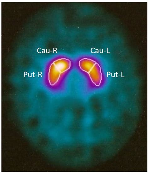 Fluphenazine-Induced Neurotoxicity with Acute Almost Transient ...