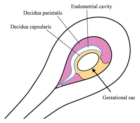Diagnostic Clues to Ectopic Pregnancy | RadioGraphics