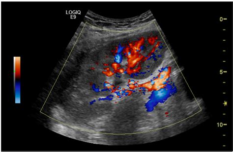 Clinical Utility of Duplex Ultrasonography in the Recognition of Transplant Renal Artery ...