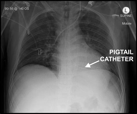 Pigtail Catheter Chest Tube Placement at Lynn Morgan blog