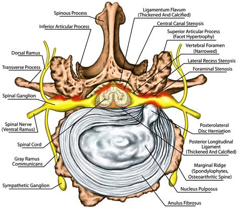 Degenerative disk disease causes, symptoms, diagnosis, exercises & treatment