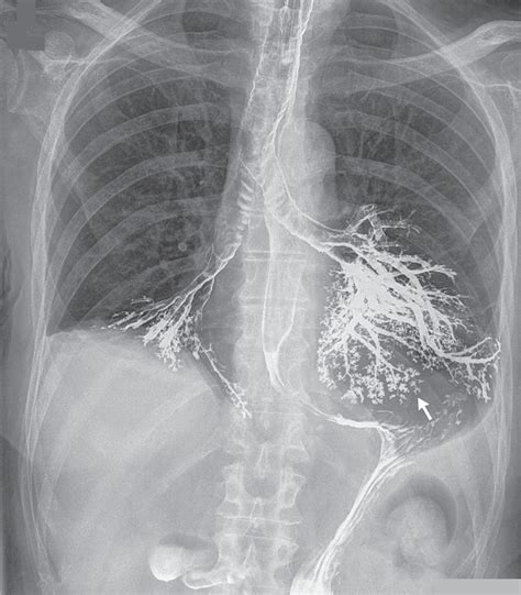Image result for Modified Barium Swallow Video Example