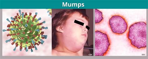 Image result for Mumps Operating System Computer Science