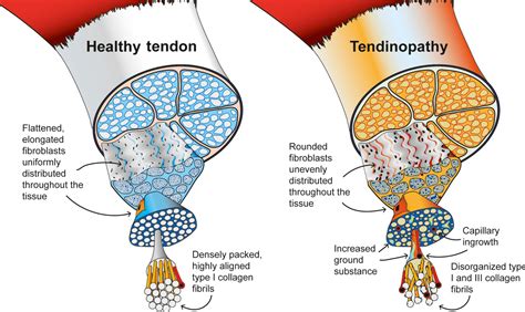 Dr David Samra | Sports Medicine Sydney | Tendon Pain