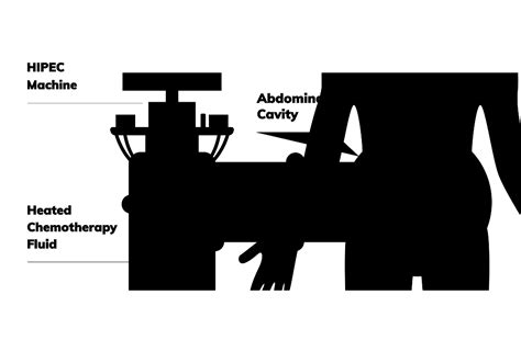 Image result for HIPEC Surgery