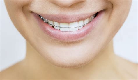 Image result for Floss Threader Fixed Retainer