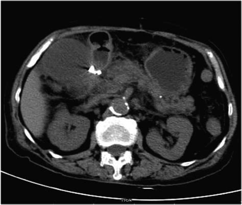 Successful closure of a duodenal perforation caused by endoscopic ultrasound with an over-the ...