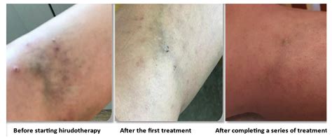 Case Reports and Experts Opinions about Current Use of Leech Therapy in ...