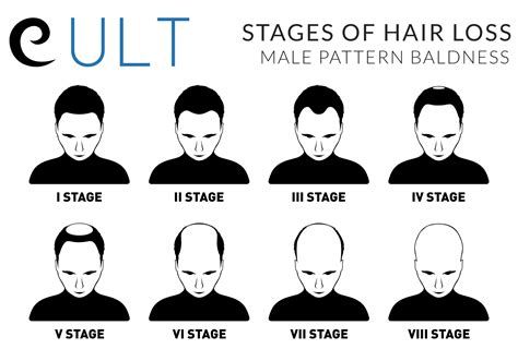 What Are The Different Types Of Male Pattern Baldness at James Roush blog